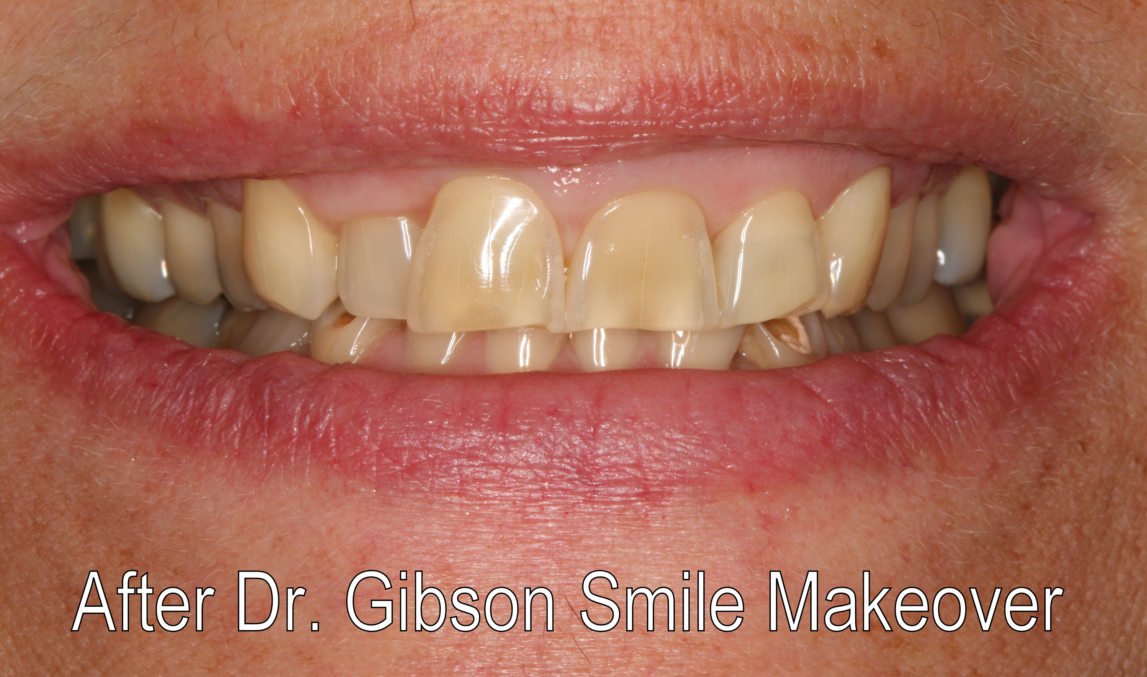 Smiles By Dr. Gibson Smile Makeover 2